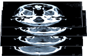 Medical Imaging - Example of slices forming 3D
